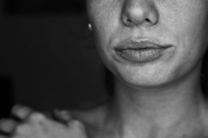 Why Do Cold Sores Flare Up More in Summer—and How Can You Prevent Them?
